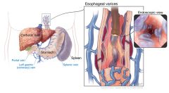 Dilated and tortuous veins in the submucosa of the esophagus caused by portal hypertension, often associated with liver cirrhosis; at high risk for rupture if portal circulation pressure rises.


 


 


 


 


 