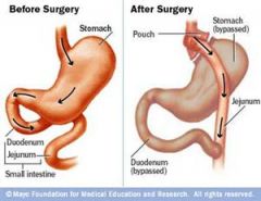 Rapid emptying of the gastric contents into the small intestine, which occurs following gastric resection


 


 


 


 