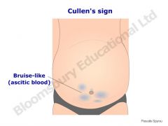 Bluish discoloration of the abdomen and periumbilical area seen in acute hemorrhagic pancreatitis.


 


 


 


 


 


 