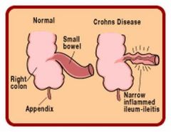 A inflammatory disease that can occur anywhere in the gastrointestinal tract but most often affects the terminal ileum; leads to thickening and scarring, narrowed lumen, fistulas, ulcerations, and abscesses. The disease is characterized by remissi...
