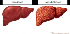 A chronic progressive disease of the liver characterized by diffuse degeneration and destruction of hepatocytes. Repeated destruction of hepatic cells causes the formation of scar tissue.


 


 


 
