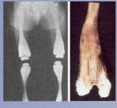 Long bones without cavities but with misshapen bulbous ends. What is the condition?