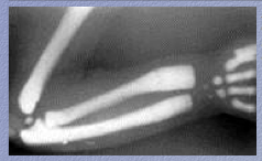 What do you notice in the X-ray? What is the condition?