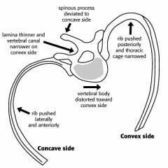 Spinous process towards Concavity

Vertebral Body towards Convexity