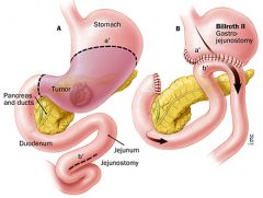 Partial gastrectomy with the remaining segment being anastomosed to the jejunum; also termed "gastrojejunostomy


 


 