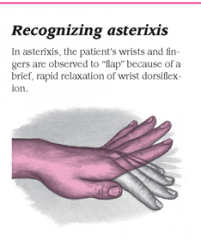A coarse tremor characterized by rapid, nonrhythmic extensions and flexions in the wrist and fingers; also termed "liver flap"


 


 