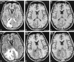 PML patients with have varying degrees of encephalitis (asymptomatic to comatose) and this is caused by reactivation of the JC virus. Diagnosis can be made by MRI by finding demylination of the white matter at multiple locations. 