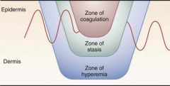 Coagulation
Cells have been destroyed, avascular

Stasis
Cells injured but should survive

Hyperaemia
Minimal thermal damage but marked inflammatory response