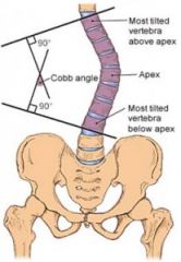 Parallel lines are drawn from the most superior and most inferior vertebral bodies and then a perpendicular line is drawn
-The angle between that intersection is the Cobb angle