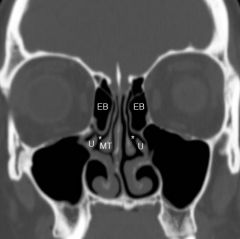 Most consistent, largest and well pneumatized anterior ethmoid air cell 

Located within the middle meatus directly posterior to the uncinate process and anterior to the basal lamella of the middle turbinate