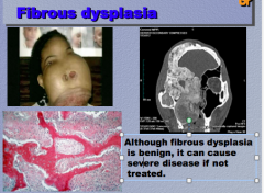 Fibrous dysplasia