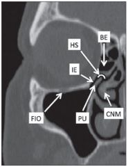 Medial: uncinate process
Lateral: lamina orbitalis
Posterior: anterior wall of ethmoid bulla
Anterior and superior: frontal process of the maxilla
Superior and lateral: lacrimal bone
