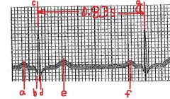 Repolarization of the ventricles is occurring at letter....