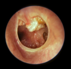 - a collection of squamous keratin (skin debris) in the middle ear and mastoid (attic/pars flaccida region)


- Produces from squamous epithelial cells (typically line ear canal)


- exhibits independent growth and locally agressive (destroys ...