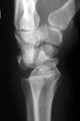 Hx:35yo professional football player c/o severe wrist pain after making a tackle. He reports paresthesias in his thumb and index finger. AP and lateral xrays of the wrist are shown in fig A & B respectively. What is the next step in management?  1...