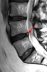 A 37-year-old male feels a "pop" in his low back while lifting a heavy object. Four weeks later he continues to have significant low back pain, with no complaints of symptoms in his leg. A T2-weighted MRI is shown in Figure A with a red arrow iden...