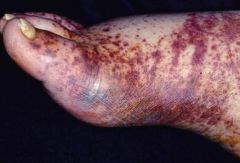 1. granulomatous vasculitis seen in patients with asthma (allergic vasculitis)
2. pulmonary infiltrates, rash, eosinophilia- systemic vasculitis may result in skin, muscle and nerve lesions
3. eosinophilia, p-ANCA
4. glucocorticoids