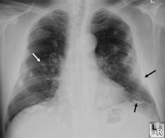1. diffuse interstitial fibrosis of the lung caused by inhalation of asbestos- predilection for the lower lobes
2. develops insidiously many years after exposure (>15-20 yrs)
3. increased risk for bronchogenic carcinoma (smoking is synergistic),...