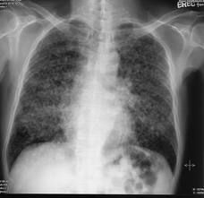 1. CXR- ground glass or honeycombed appearance, but may be normal
2. definitive diagnosis requires open lung biopsy, but even this may show non-specific findings
3. other causes of ILD must be excluded