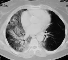 1. interstitial pulmonary inflammation -- occurs in 5-15% of patients that undergo thoracic radiation for lung cancer, breast cancer, lymphoma, or thymoma
2. mortality and morbidity are related to the irradiated lung volume, dose, patient status ...