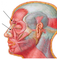 – Attachments:
• Fascia on dorsum of nose and lateral nasal cartilage
• Skin of inferior forehead between brows
– Action
• Depresses medial end of brow, wrinkles skin on dormsum of nose
– Innervation: Buccal br. of facial nerve