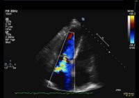 The color flow Doppler demonstrates:
a) normal TR
b) moderate TR
c) mild TR
d) pulmonary HTN