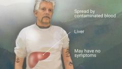  
Hepatitis is liver inflammation. Hep A, B, & C can cause similar symptoms, but are each caused by different viruses and effect the liver in different ways.