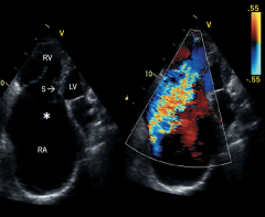The TR:
a) is mild
b) shows pulm HTN 
c) makes the diagnosis of Ebstein's 
d) is underestimated in this view