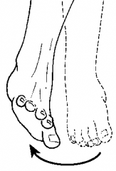 Movement of the sole away from the midline
Probably a broken bone