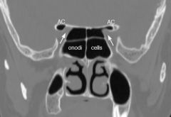 Sphenoethmoidal Cells = Onodi cells

Increased pneumatization of the sphenoid sinus that can expose the optic nerve and the internal carotid artery at put them at risk during surgery