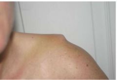 Etiology/Symptoms/Diagnosis
Acromioclavicular (AC) Dysfunction (pic is a grade III AC separation)