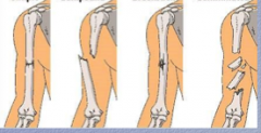 What are the three types of fractures shown?