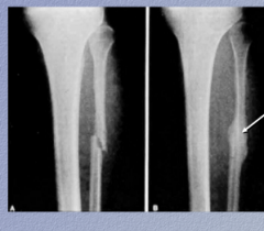 In this recent fracture of the fibula, identify the callus.