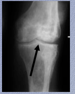 Osteonecrosis in sickle cell disease:
 
Chronic ______ + secondary osteoarthritis with advanced changes of irregular sclerosis + ________ on both sides of the knee joint reflecting numerous poor infarcts. What is narrowed?