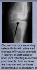 Narrowed due to secondary osteoarthritis