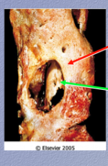 Identify "involucrum" and "sequestrum" in this osteomyelitis image.