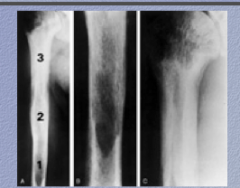 What is the disease? Identify 1, 2, and 3 (phases)