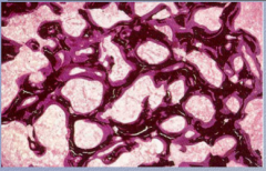 What is the disease? What stain is used? Surfaces of _________ (black) are covered by a layer of ___________ (dark pink).