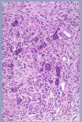 Hyperparathyroidism:
 
What is is this an image of? What is mixed with osteoclasts?