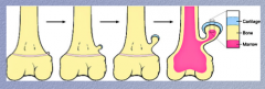 Osteochondroma:
 
Initially at the the epiphyseal plate, there is a small out pouching of ________, which grows proximally to the _________ and comes to resemble a finger growing out of the bone with a cap of cartilage over it.