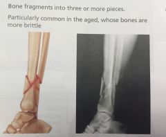 What type of fracture is this?