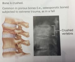 What type of fracture is this?