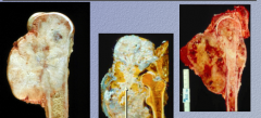 What is the neoplasm? 
 
What does the arrow indicate? What do osteosarcomas produce that DOES NOT COMMONLY mineralize?