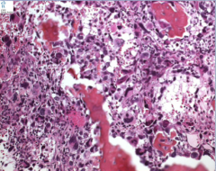 What is the neoplasm? Do you see any pattern here? What bizarre cells are common? What else common (think rapid division)?