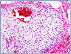 What type of neoplasm? What do the cells mimic and appear to float on? 
 
Comment on size of nuclei, nuclear/cytoplasmic ratio, and mitotic figures (numbers of each)
