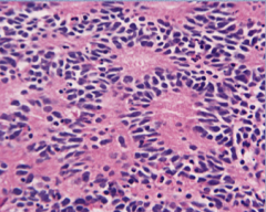 What is the neoplasm?  What is the name of the rosettes? Which cells are tumor and which is the fibrillar material? What does this suggest?