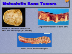 Common cancers to metastasize to bone?