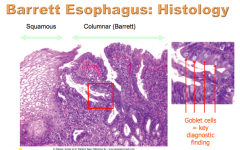 What is the key diagnostic finding of Barrett esophagus? 
 
What is the TYPE of metaplasia?
