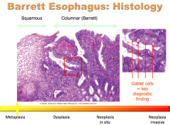 Goblet cells => intestinal metaplasia!