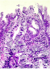 What is the condition? Describe the polarization of glandular cells, nuclei, and maturation. What is this (metaplasia, etc)?